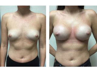 Antes y después de Aumento de busto - Dr. Mario Vélez Palafox