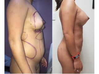 Antes y después de Lipoabdomino+implantes - Dr. Mario Vélez Palafox