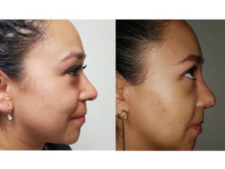 Antes y después de Rinoplastia+Bichectomia - Dr. Mario Vélez Palafox