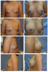 Antes y después de una Mamoplastia