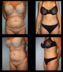 Antes y después de Abdominoplastia