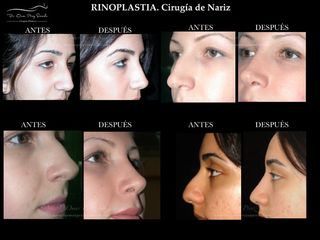 Antes y después de Rinoplastia