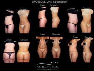 Antes y después de Lipoescultura