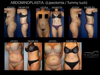 Antes y después de Abdominoplastia