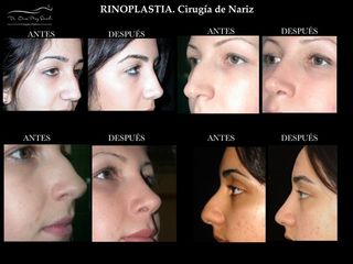 Antes y después de Rinoplastia