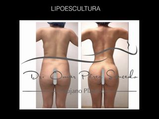 Antes y después de Lipoescultura