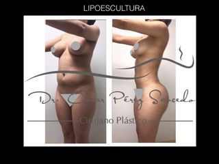 Antes y después de Lipoescultura