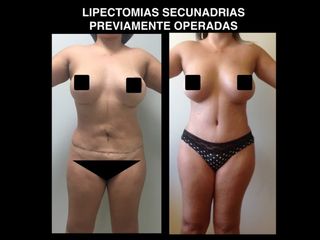 Antes y después de Abdominoplastia