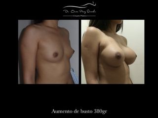 Antes y después de Aumento de Busto