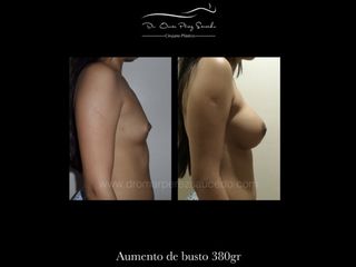 Antes y después de Aumento de Busto