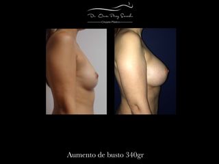 Antes y después de Aumento de busto