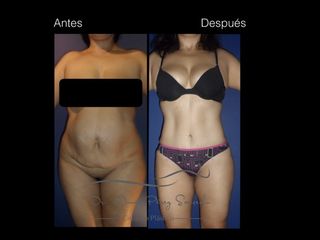 Antes y después de Abdominoplastia