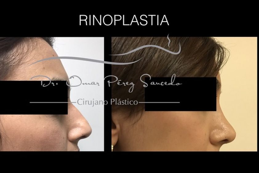 Rinoplastia antes y después - 590038