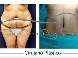 Antes y despues de Lipectomia