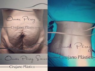 Antes y después de Abdominoplastia