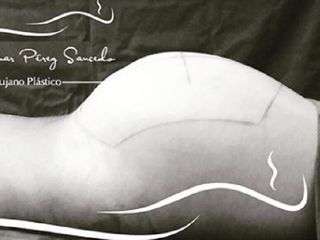 Antes y despues de Aumento de glúteos por medio de Lipotransferencia de grasa