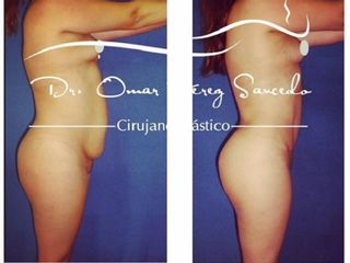 Antes y despues de lipectomia