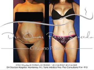 Antes y despues de lipectomia