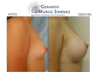 Antes y después de Aumento mamario con implantes