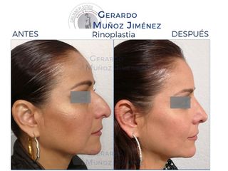 Antes y después de Rinoplastia