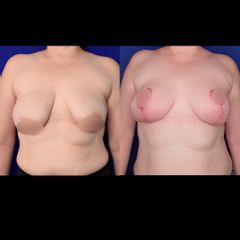 Antes y después de Reducción de mamas 