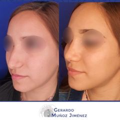 Antes y después de Rinoplastia