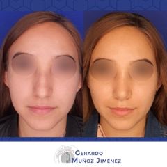 Antes y después de Rinoplastia