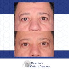 Antes y después de Blefaroplastia