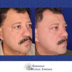 Antes y después de Rinoplastia