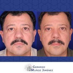 Antes y después de Rinoplastia