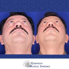 Antes y después de Rinoplastia