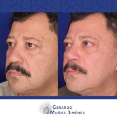 Antes y después de Rinoplastia