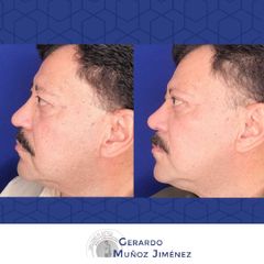 Antes y después de Rinoplastia