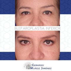 Antes y después de Blefaroplastia