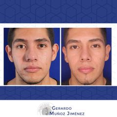 Antes y después de Rinoplastia