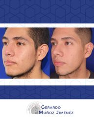 Antes y después de Rinoplastia