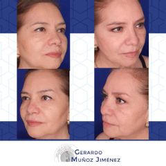 Antes y después de Blefaroplastia
