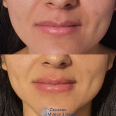 Aumento de labios - Dr. Gerardo Muñoz Jiménez