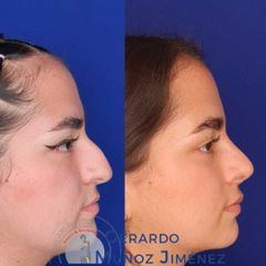 Antes y después de Rinoplastia