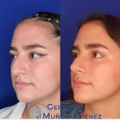 Antes y después de Rinoplastia