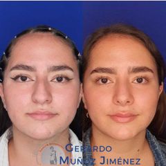 Antes y después de Rinoplastia