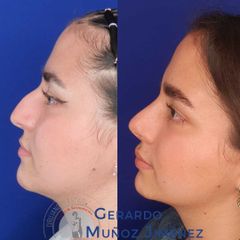 Antes y después de Rinoplastia