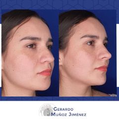 Antes y después de Rinoplastia