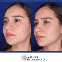 Antes y después de Rinoplastia