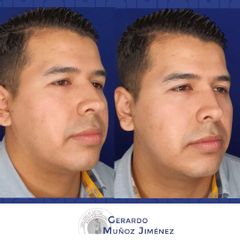 Rinomodelación - Dr. Gerardo Muñoz Jiménez
