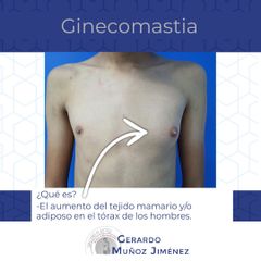 Ginecomastia