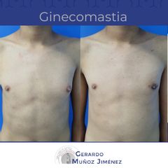 Antes y después de Ginecomastia 