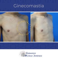 Antes y después de Ginecomastia 