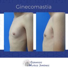 Antes y después de Ginecomastia 
