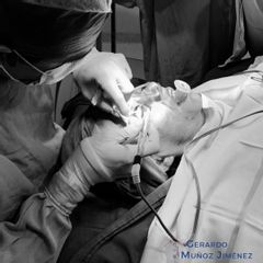Blefaroplastia